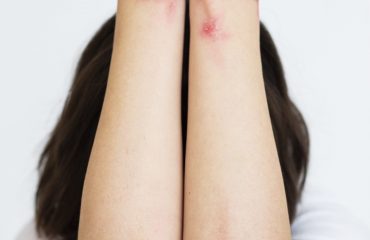 hands-patient-suffering-from-psoriasis