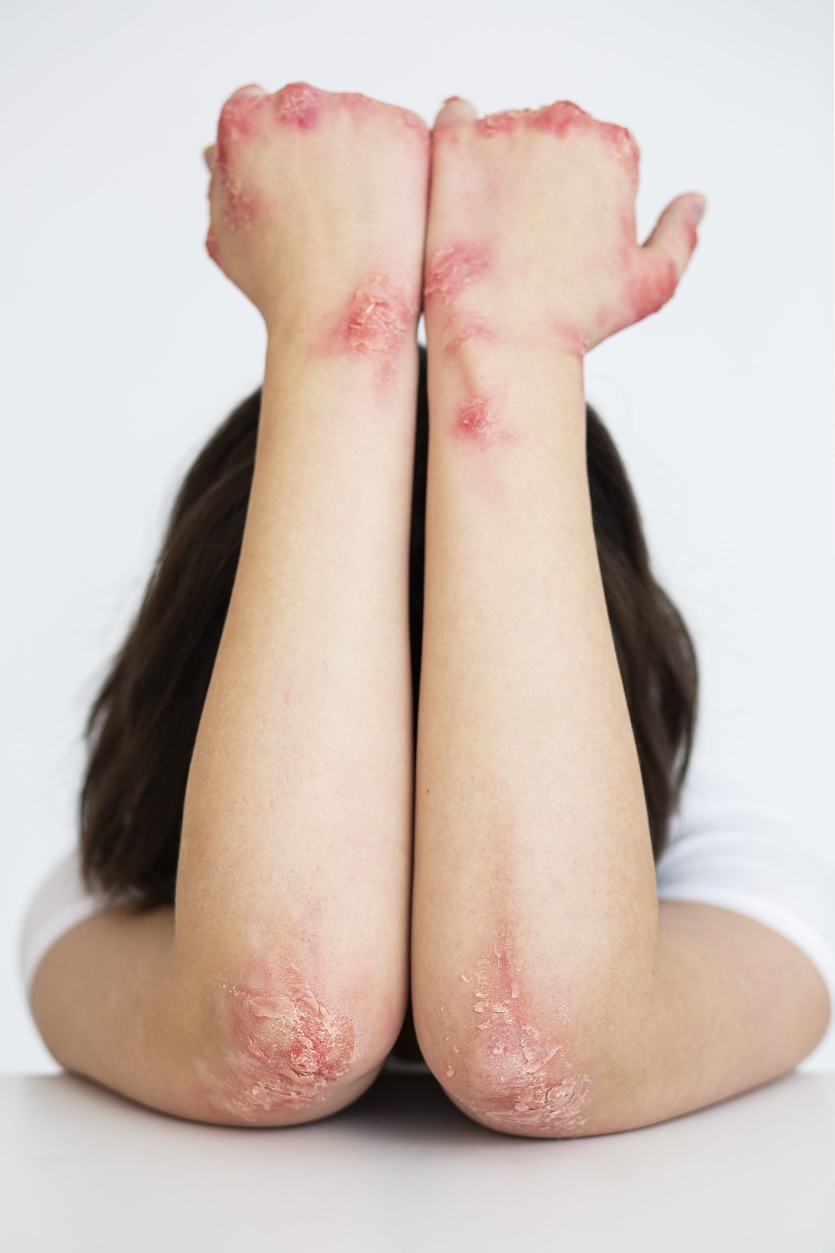 hands-patient-suffering-from-psoriasis